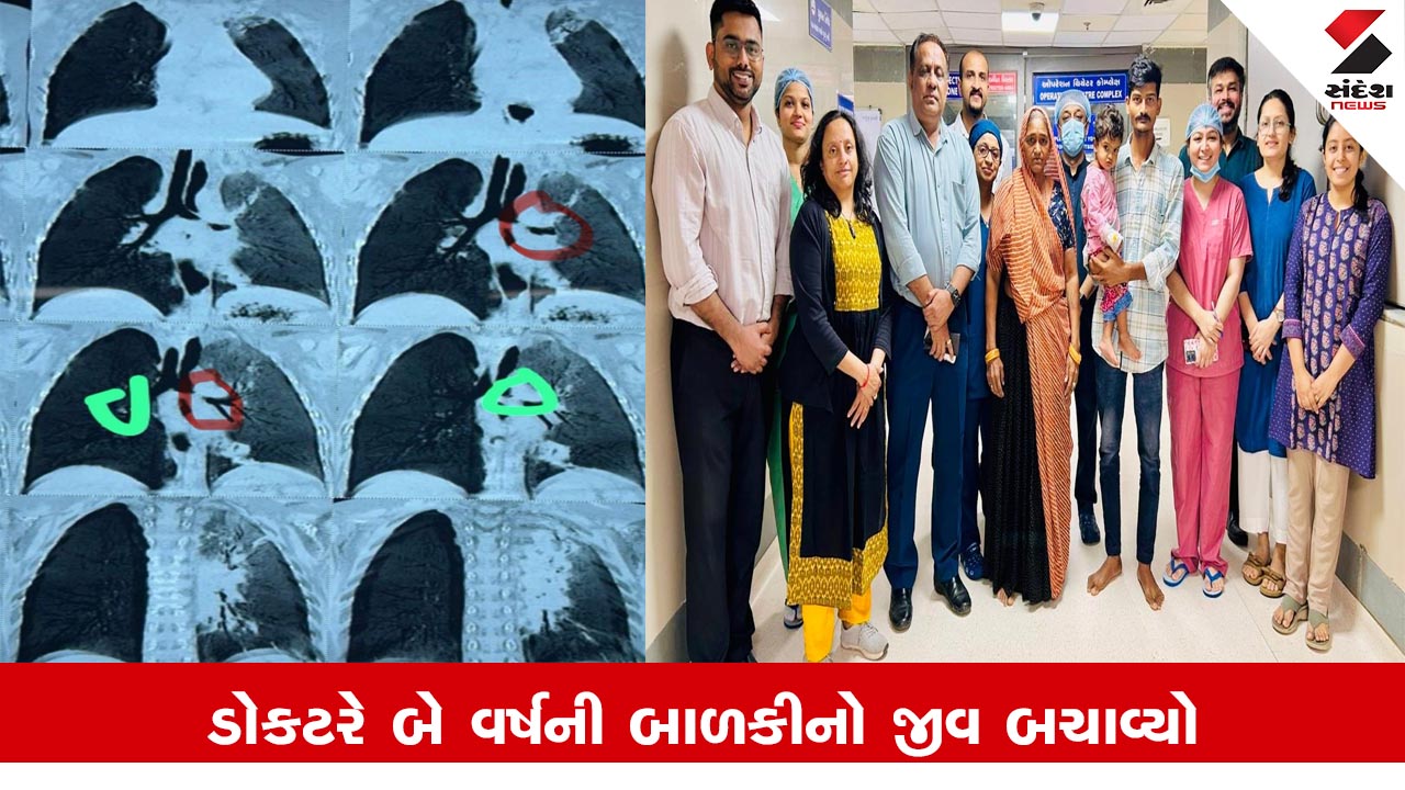 અમદાવાદ: સિવિલ હોસ્પિટલના ડોક્ટરોએ શ્વાસનળીમાંથી મગફળીના દાણા કાઢી બે વર્ષની બાળકીનો જીવ બચાવ્યો.