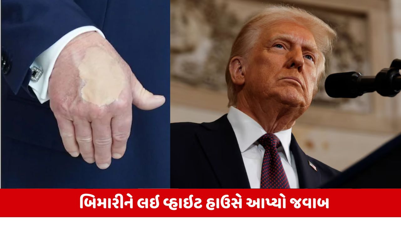 Donald Trumpના હાથને શું થયુ?: રાષ્ટ્રપતિ કઇ બિમારી છુપાવી રહ્યા છે? હાથ પર મેકઅપના ફોટા વાયરલ.