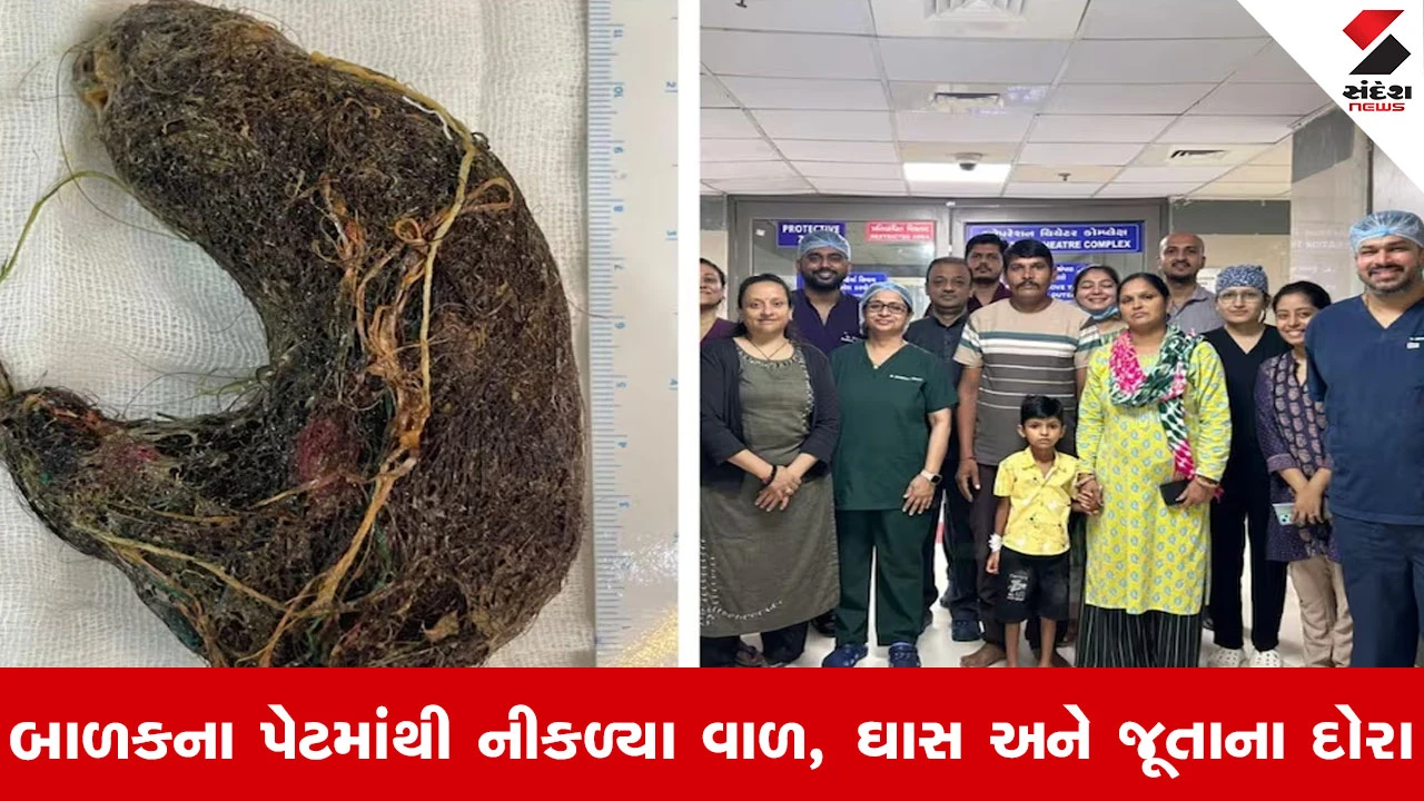 Ahmedabad News : ટ્રાઇકોબેઝોઅરનો દુર્લભ કેસ, શુભમ નિમાણાને અમદાવાદ સિવિલ હૉસ્પિટલમાં મળ્યું નવું જીવન