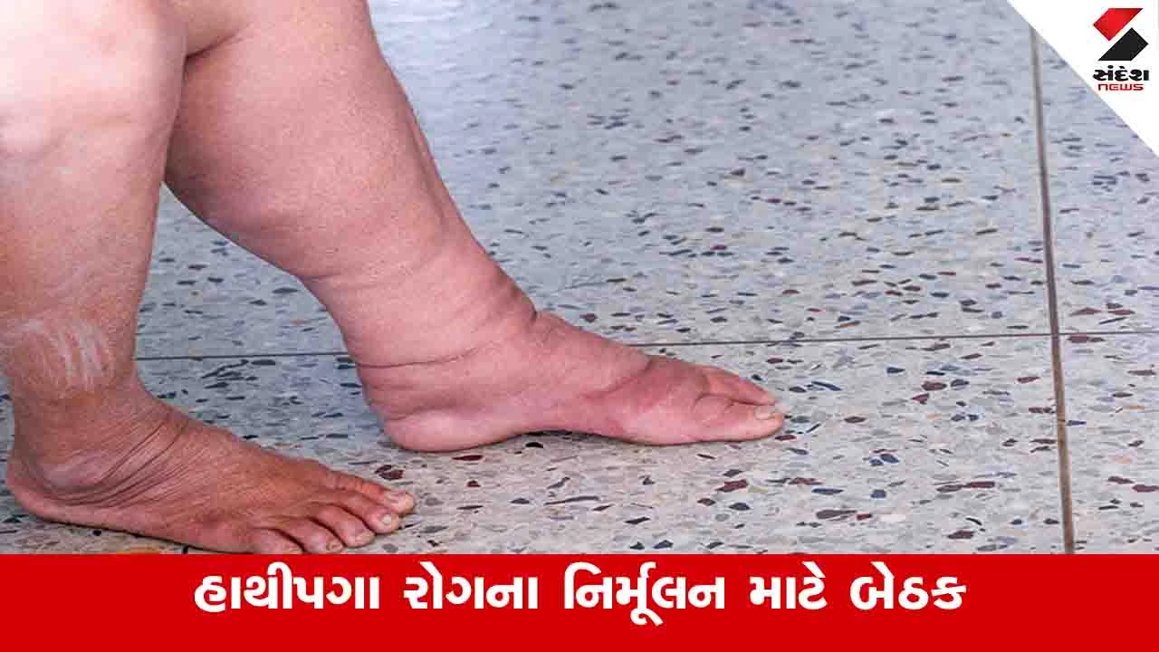 Gandhinagar News: રાજ્યમાં હાથીપગાને અટકાવવા 10 અને 12 ફેબ્રુઆરીએ સામૂહિક દવા વિતરણ કરાશે 