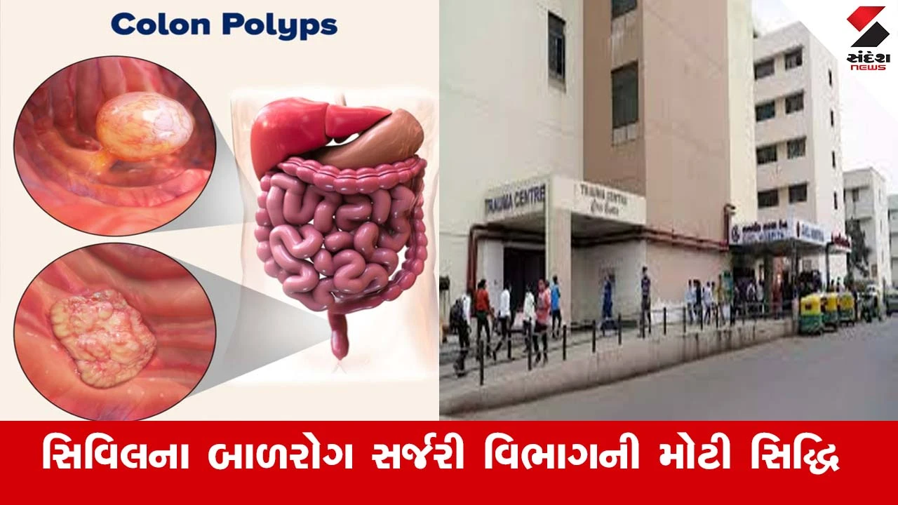 Ahmedabad News : 8 વર્ષના બાળકનો જોખમી મોટા આંતરડાનો પોલીપ (ગાંઠ) સફળતાપૂર્વક ઓપન સર્જરી વગર એન્ડોસ્કોપીથી દૂર કરાઈ 