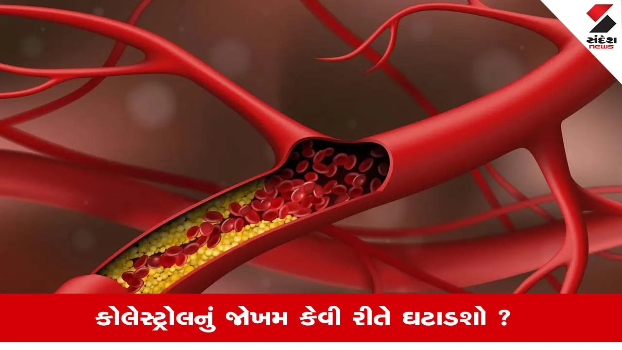 High Cholesterol: શું તમે પણ શિકાર છો હાઇ કોલેસ્ટ્રોલના?, તો આ વસ્તુઓનો કરો ત્યાગ